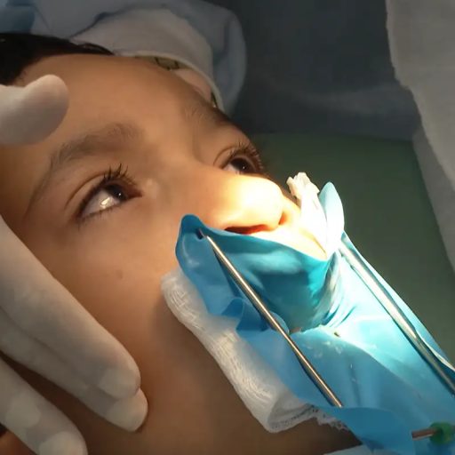 Tratamento cedo da fissura labiopalatina e equipe mudam o futuro.